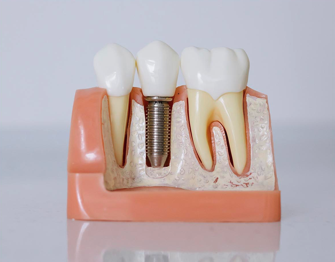 Dental Implants